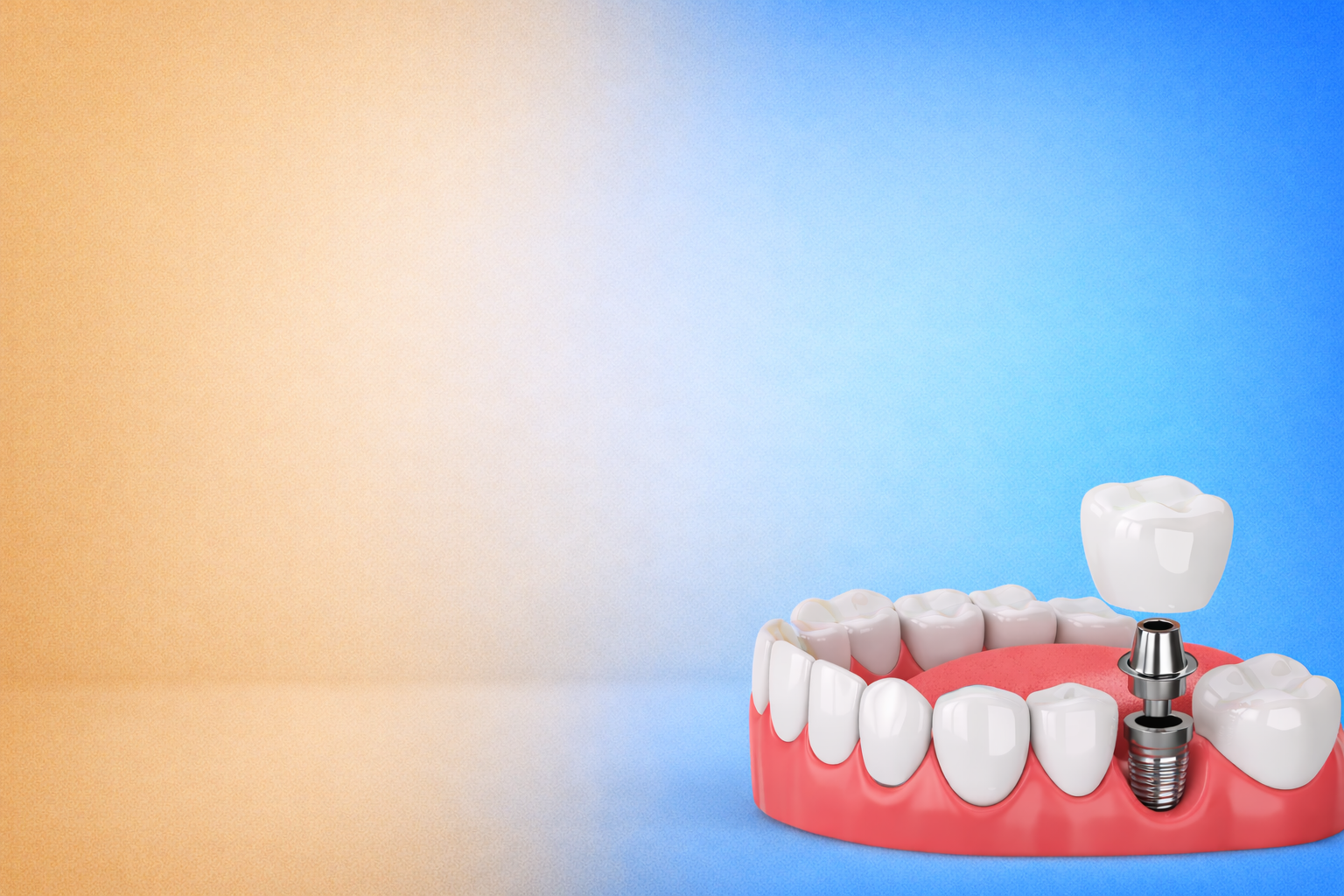 Dental Implant Slide